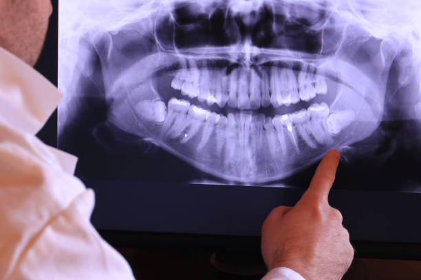 Best Emergency Tooth Extraction in Dranesville, VA