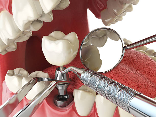 Best Emergency Tooth Extraction in Dranesville, VA